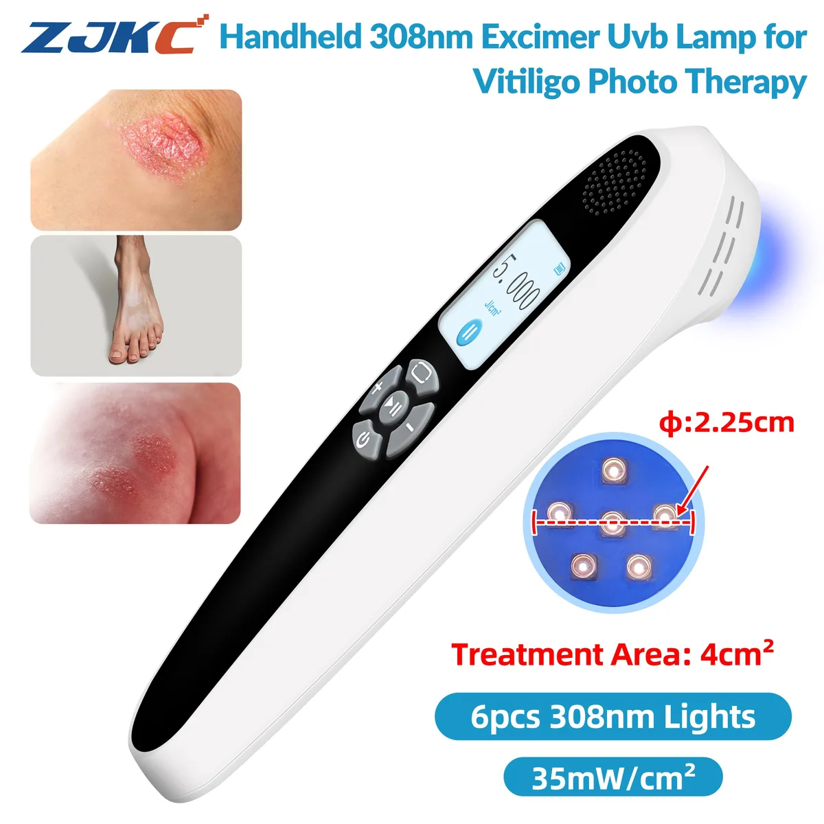 ZJKC ZJKC 308nm Excimer UVB Phototherapy Device 35mW Home Health Care — product photo